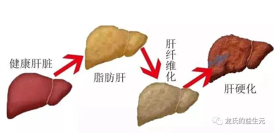 腸道菌群和脂肪肝有關系嗎？